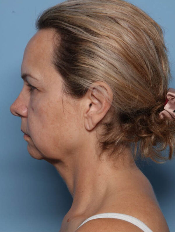 Deep Necklift