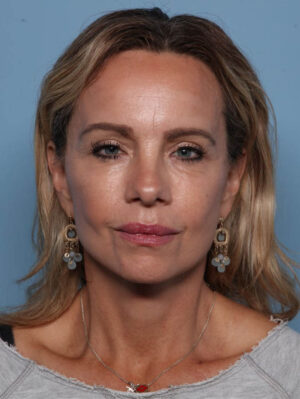 Deep Necklift