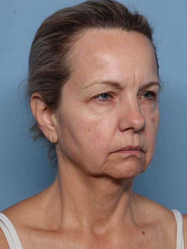 Deep Necklift