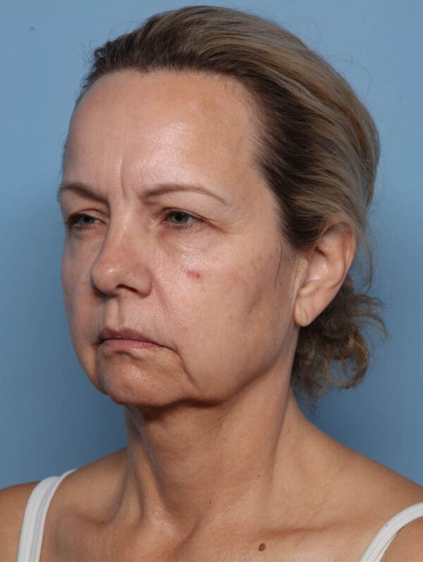 Deep Necklift