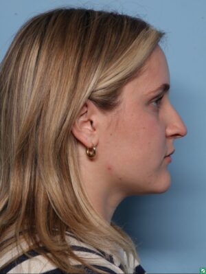 Rhinoplasty
