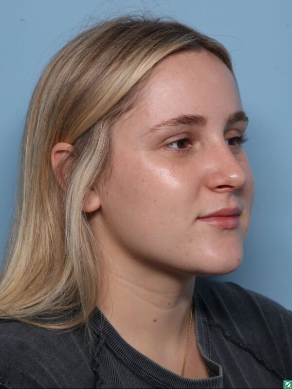 Rhinoplasty
