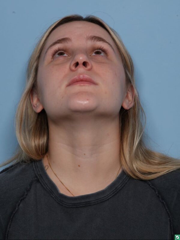 Rhinoplasty
