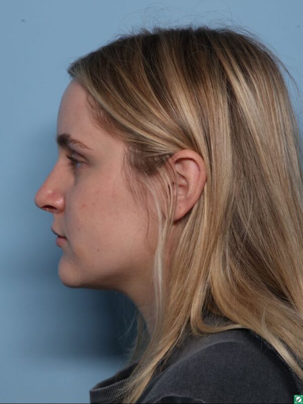 Rhinoplasty