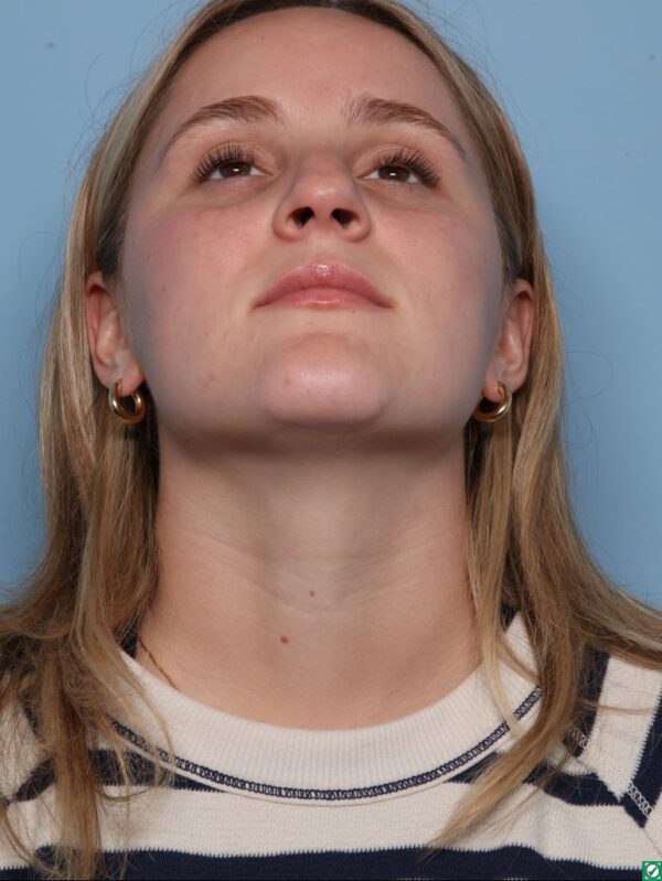 Rhinoplasty