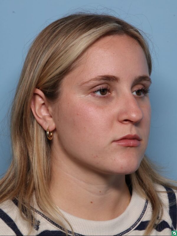 Rhinoplasty