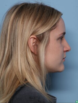 Rhinoplasty