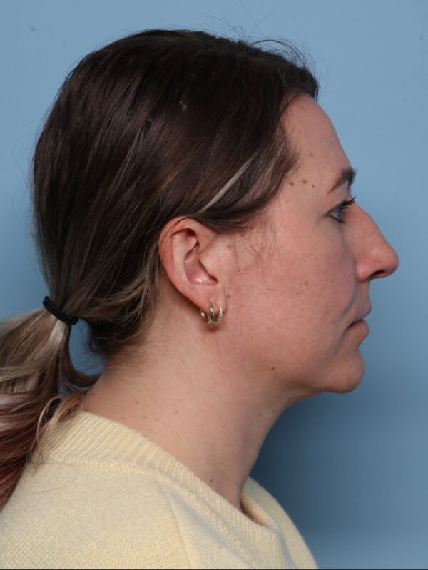 Rhinoplasty
