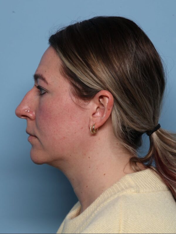 Rhinoplasty