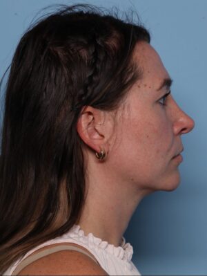 Rhinoplasty