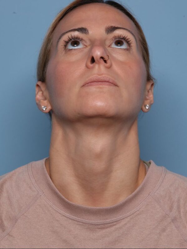 Rhinoplasty