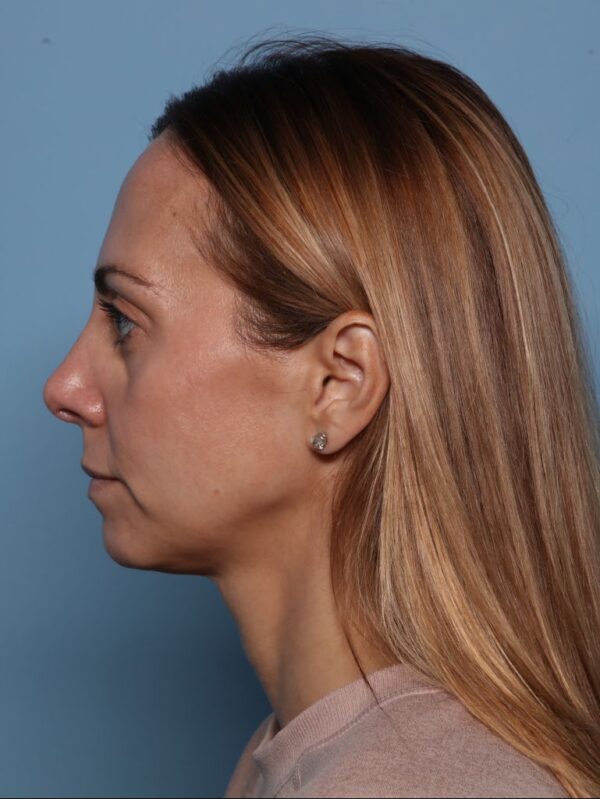 Rhinoplasty