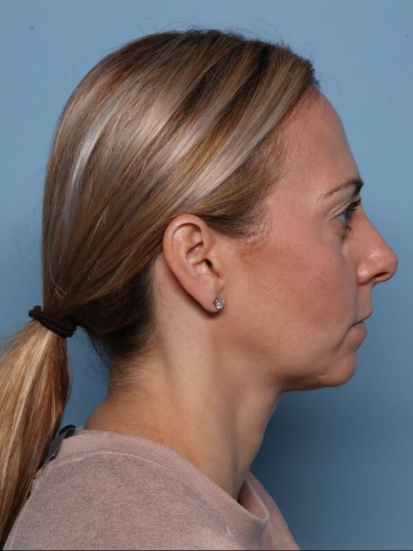 Rhinoplasty