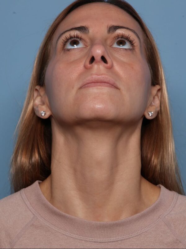 Rhinoplasty