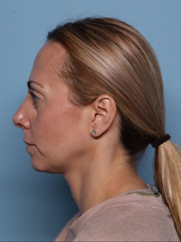 Rhinoplasty