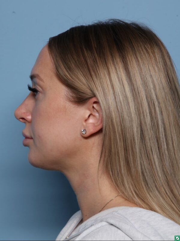 Rhinoplasty