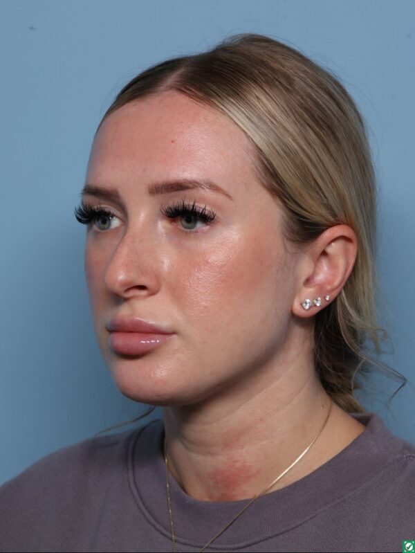 Rhinoplasty