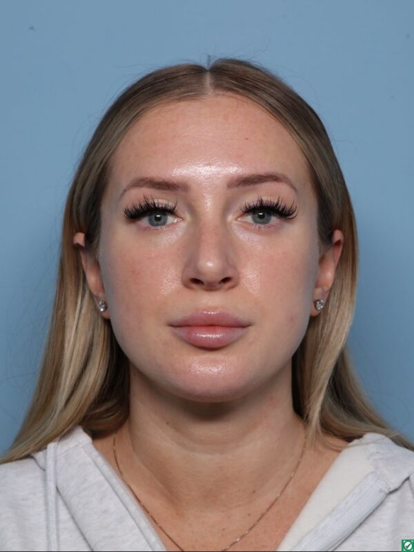Rhinoplasty