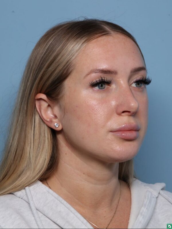 Rhinoplasty