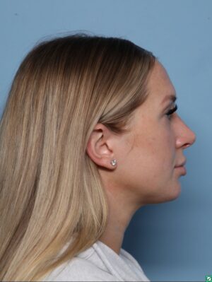 Rhinoplasty
