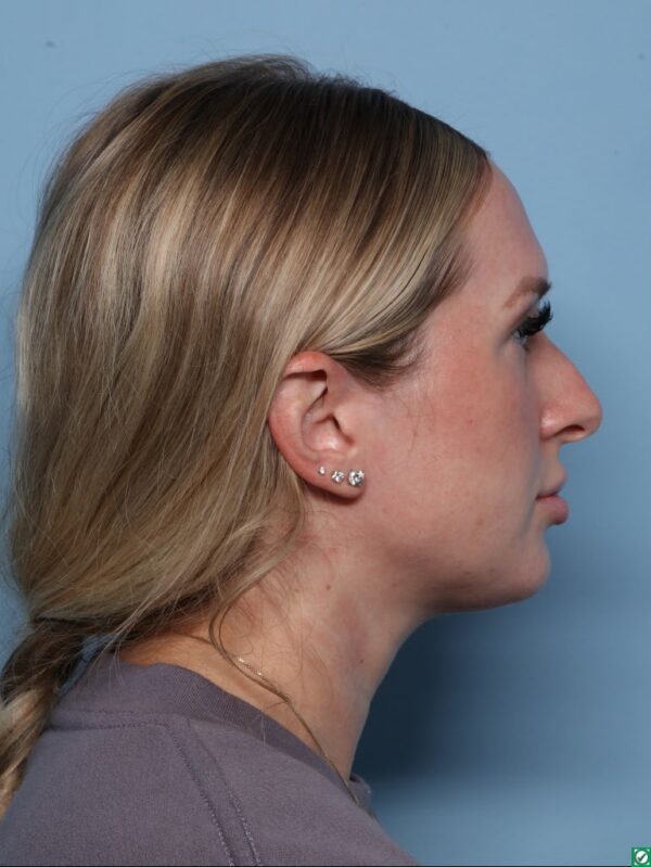 Rhinoplasty