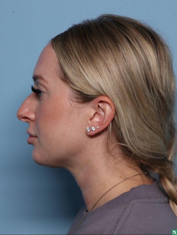 Rhinoplasty