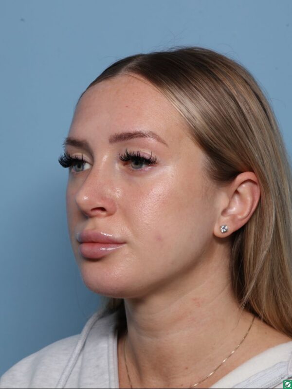 Rhinoplasty