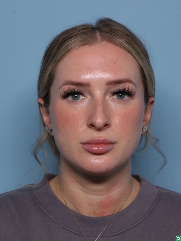Rhinoplasty