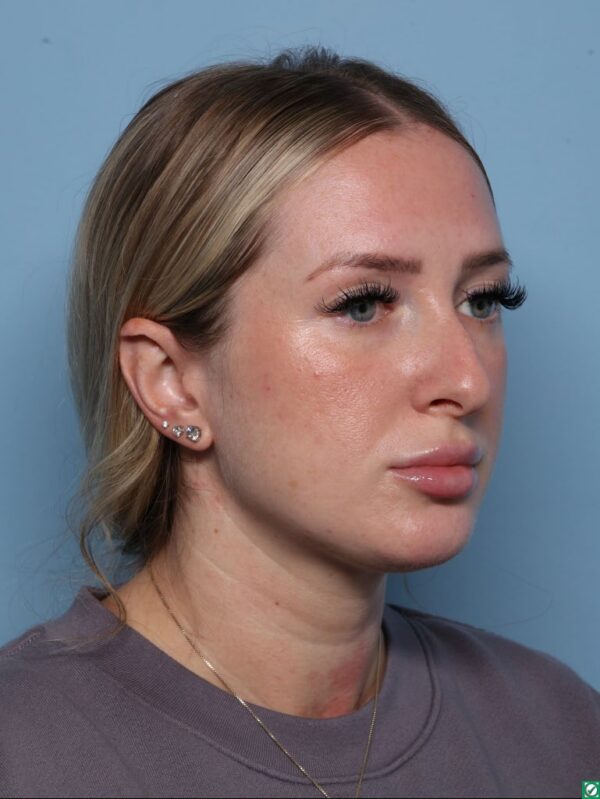 Rhinoplasty