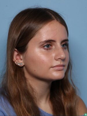 Rhinoplasty