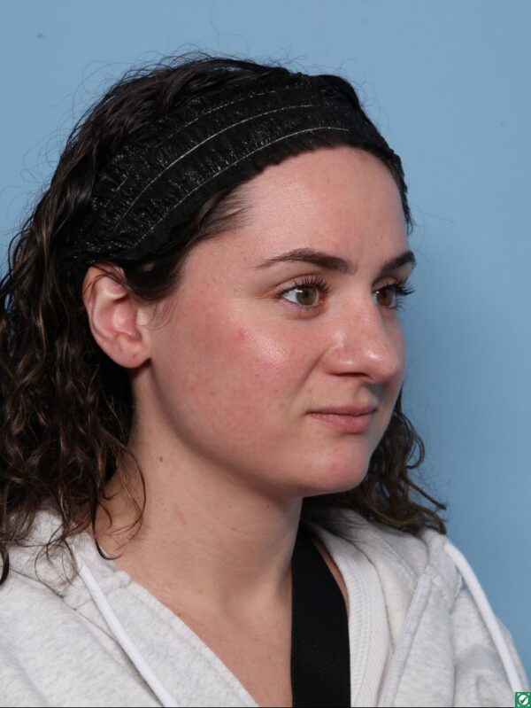 Rhinoplasty