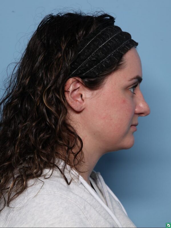 Rhinoplasty