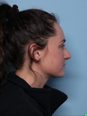 Rhinoplasty