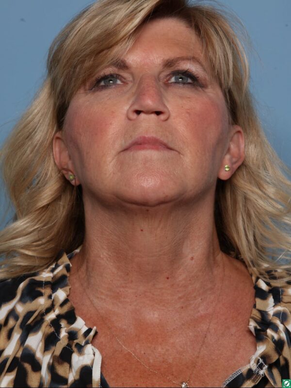 Rhinoplasty