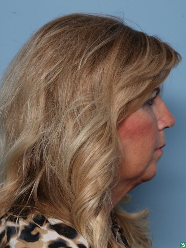 Rhinoplasty