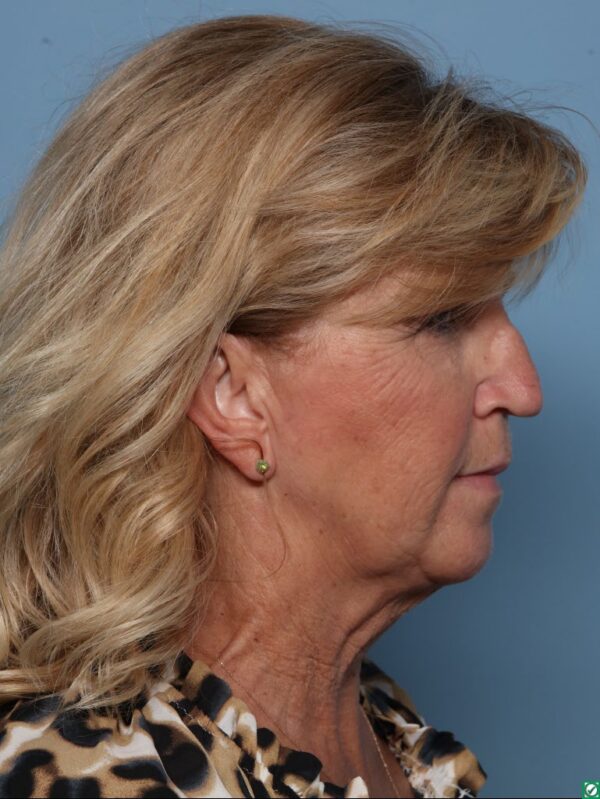 Rhinoplasty