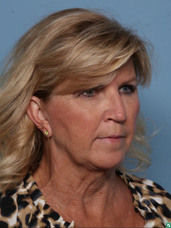 Rhinoplasty