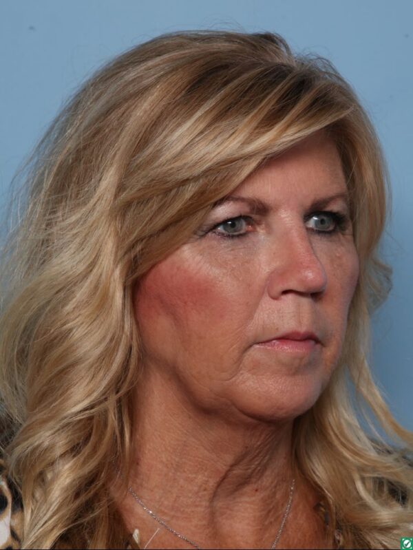 Rhinoplasty
