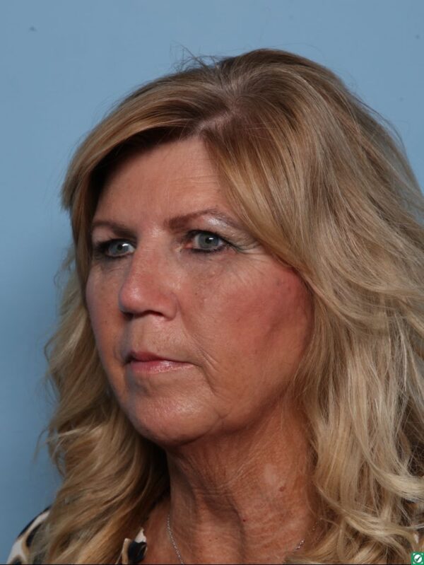 Rhinoplasty