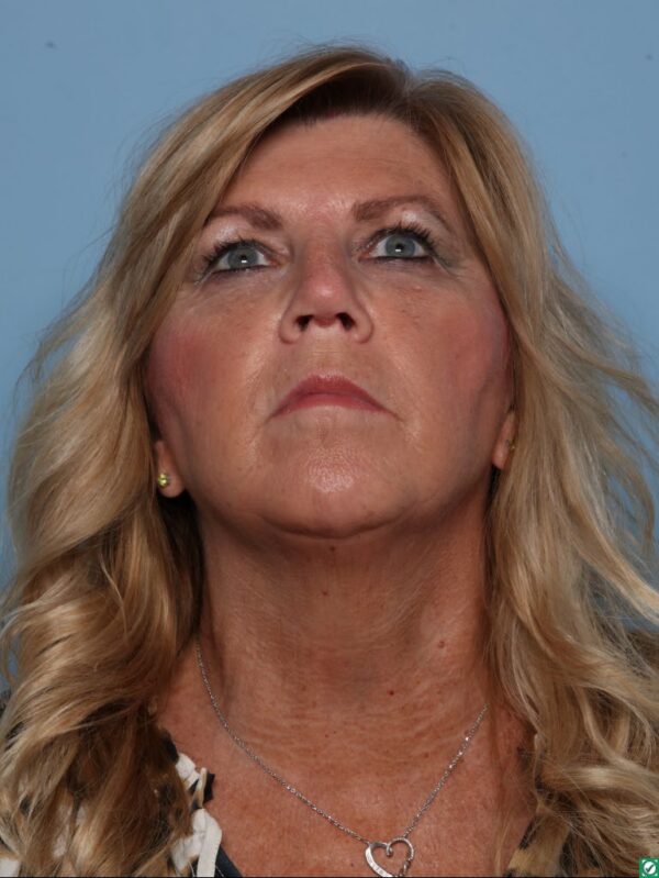 Rhinoplasty