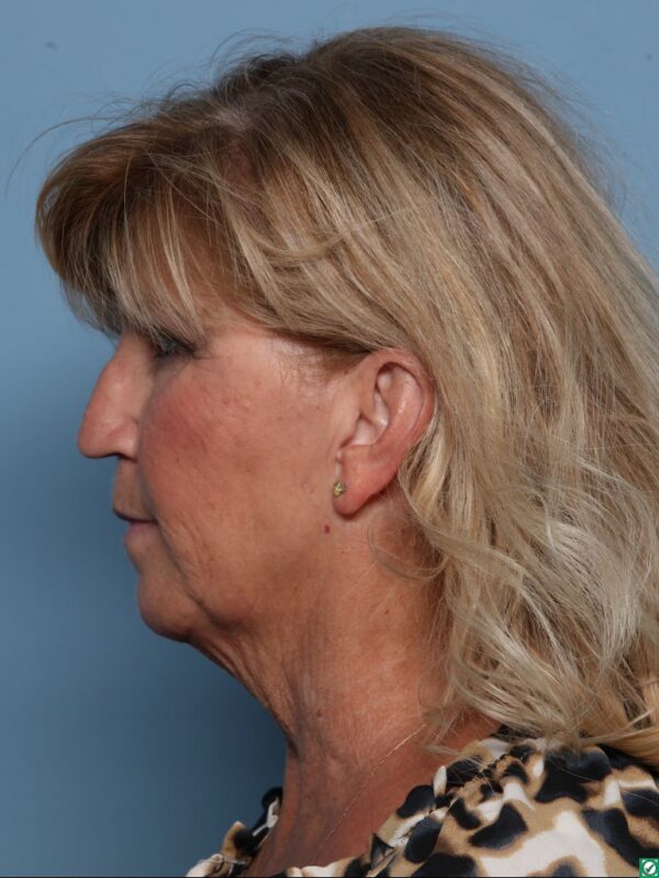 Rhinoplasty