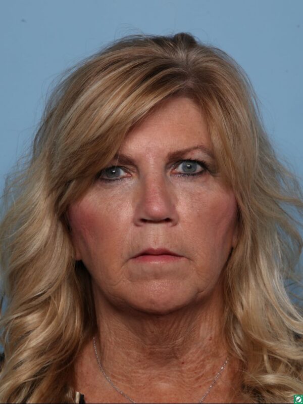 Rhinoplasty
