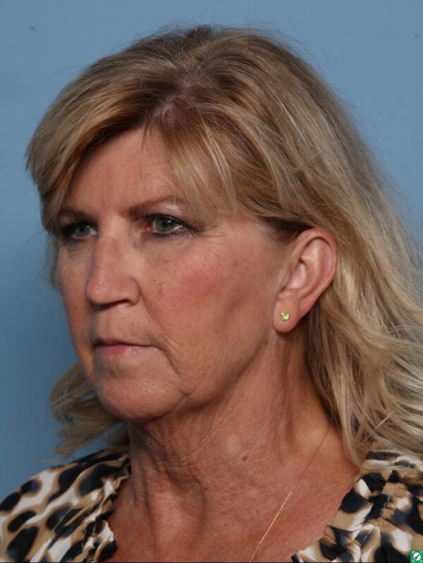 Rhinoplasty