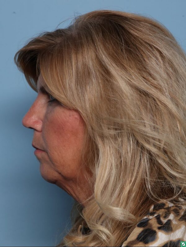 Rhinoplasty