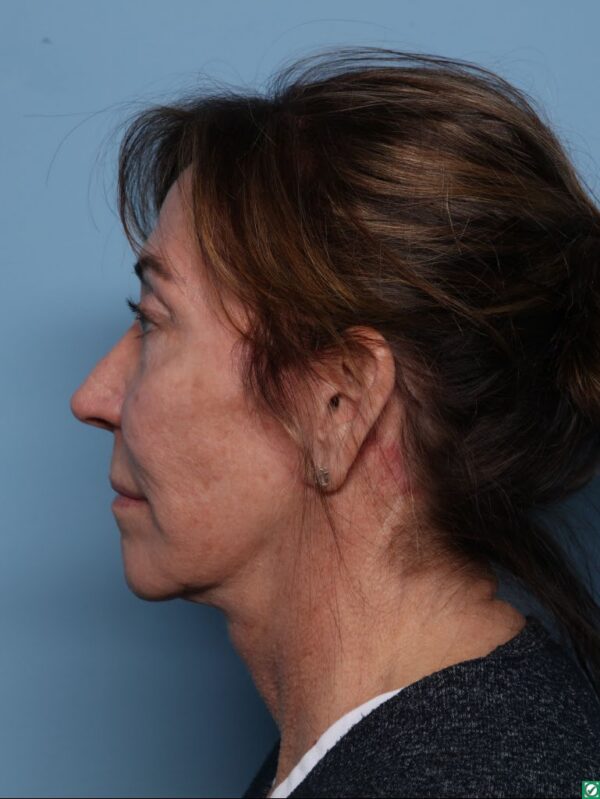 Deep Necklift