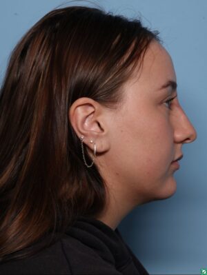 Liquid Rhinoplasty