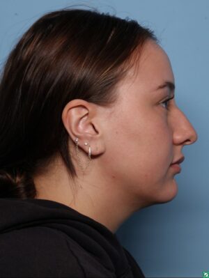 Liquid Rhinoplasty