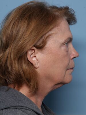 Lower Blepharoplasty