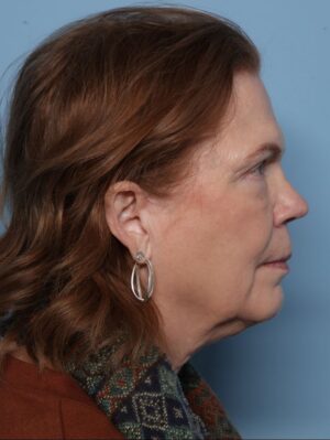 Lower Blepharoplasty