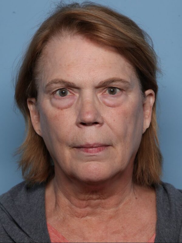 Lower Blepharoplasty